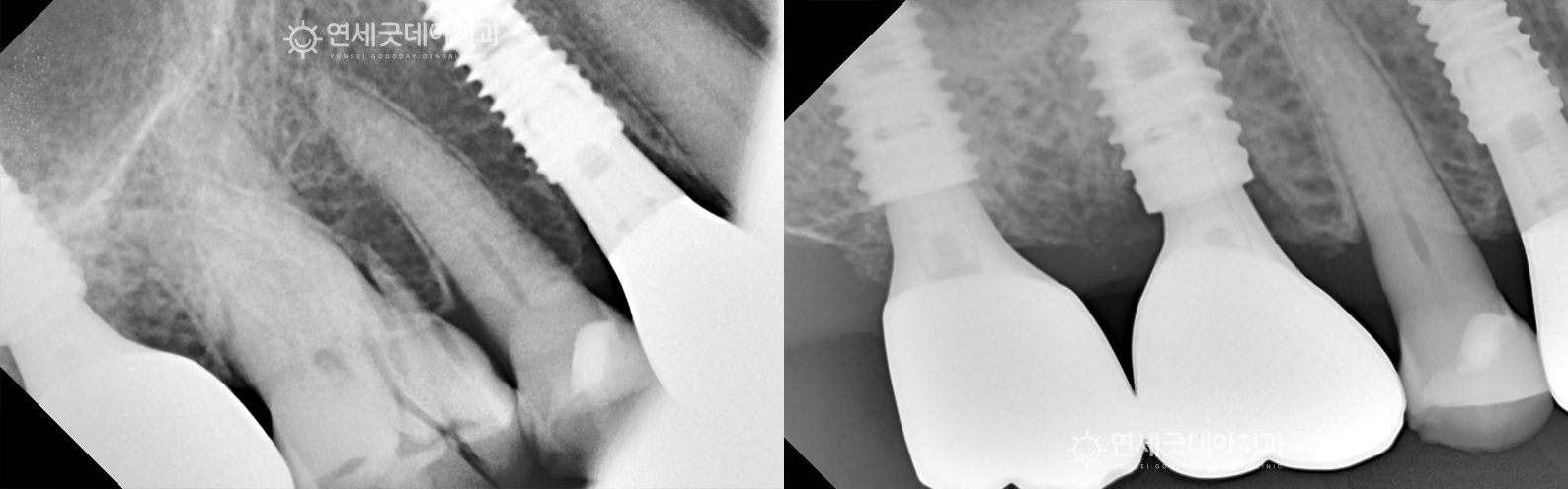 치아부러짐으로 인한 어금니 임플란트 치료전후 비교 (X-Ray)