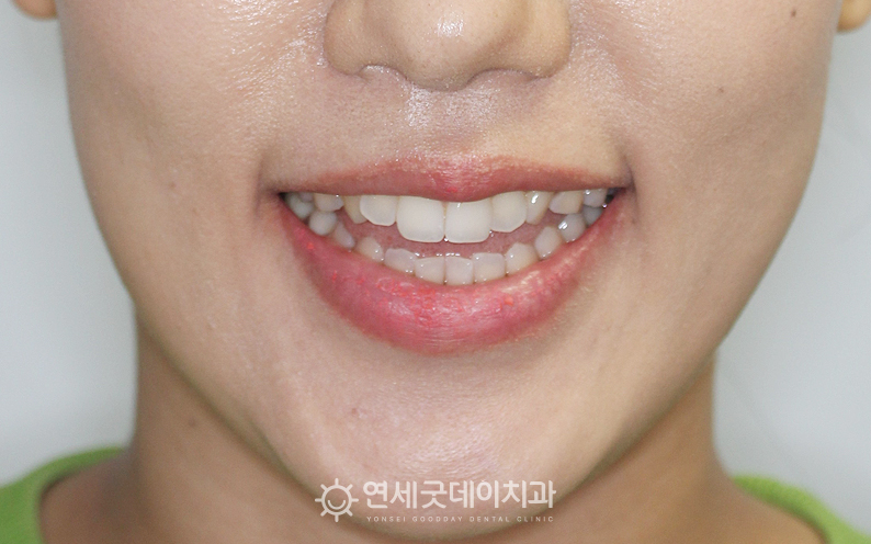 개방교합(오픈바이트)교정 전 안모