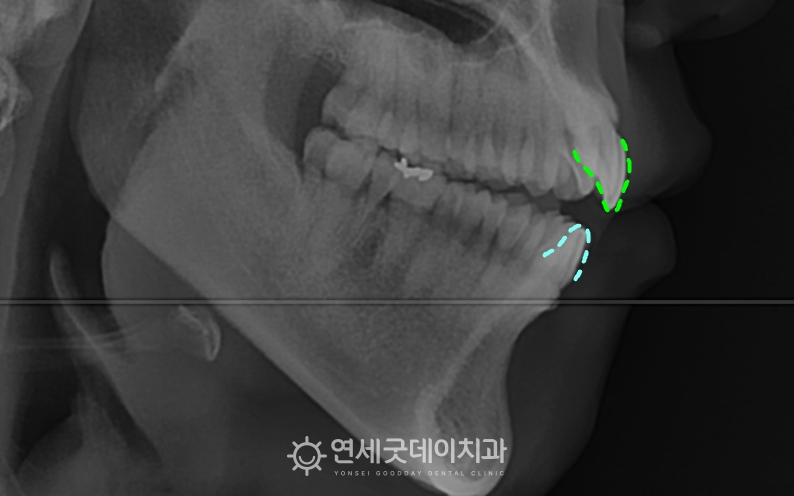 위아래가 뜨는 개방교합으로 인비절라인 교정 계획 수립