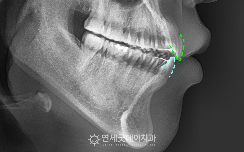 인비절라인을 이용한 오픈바이트 교정 종료 후 엑스레이