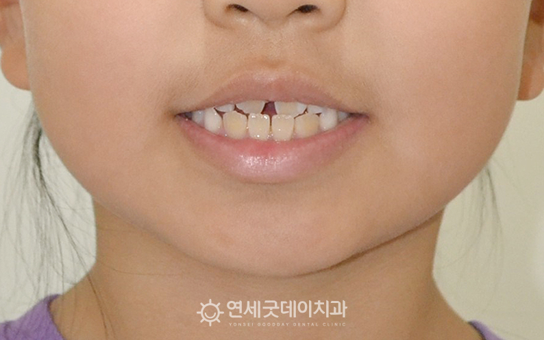 어린이 부정교합으로 인해 1차교정 상담 진행. 프리올소 진행 전
