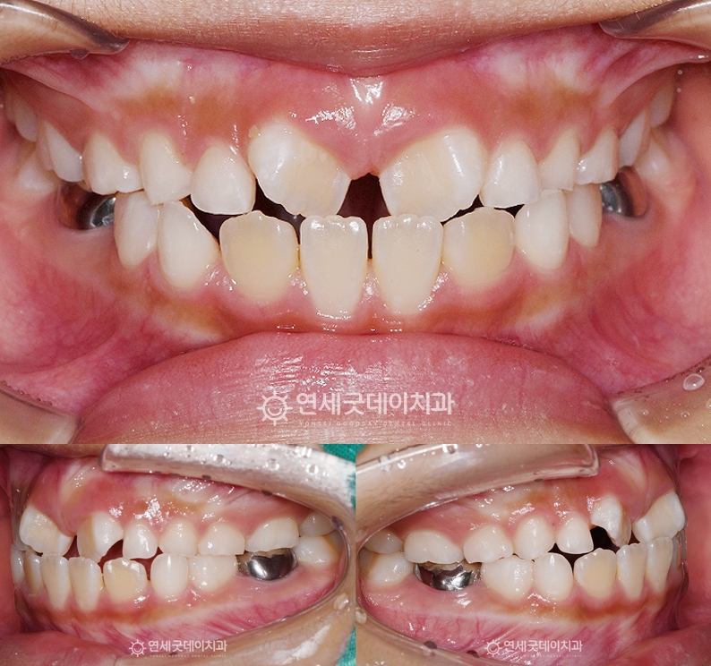 어린이 부정교합(반대교합)으로 인해 프리올소 교정 계획