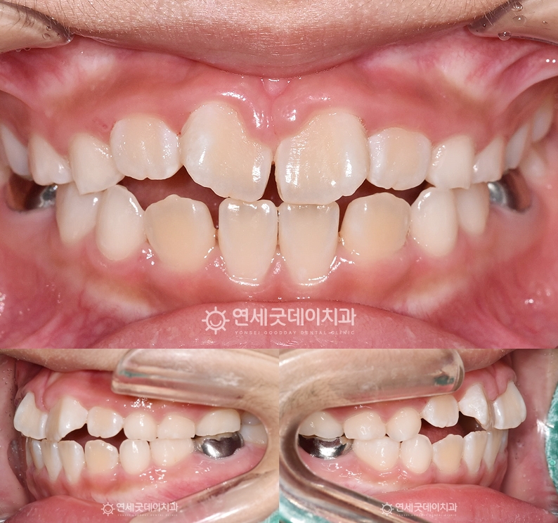 프리올소 교정 후 어린이 반대교합이 개선되는 모습