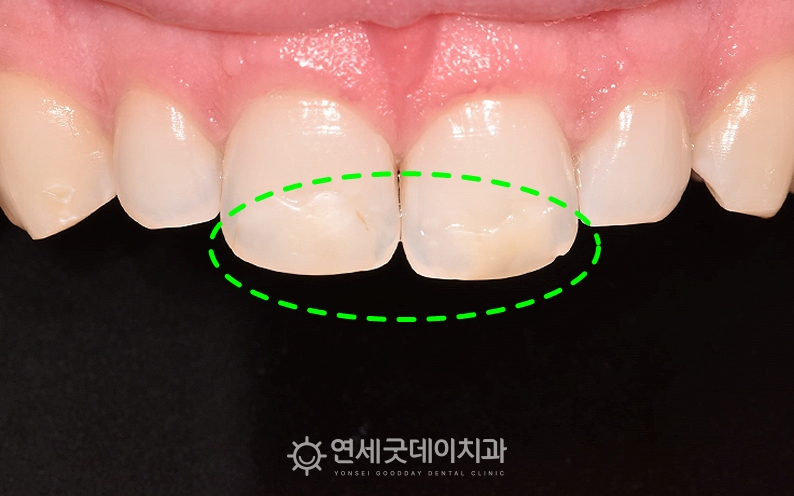 앞니 라미네이트 치료 전 앞니 길이가 다르고 레진이 변색된 모습