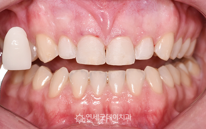 앞니 라미네이트 치료 과정
