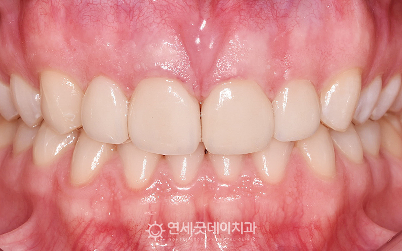 앞니 라미네이트 및 치아미백 치료 후 모습
