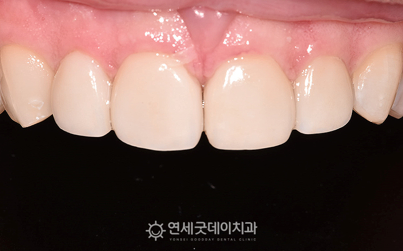 앞니 라미네이트 및 치아미백치료 후 심미성이 개선된 모습
