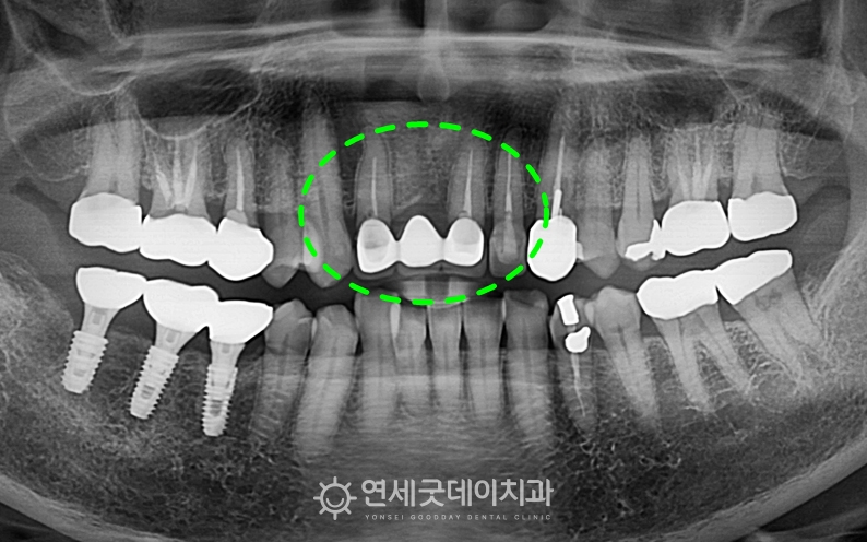 오래된 보철물이 흔들리며, 앞니 임플란트 브릿지 진단