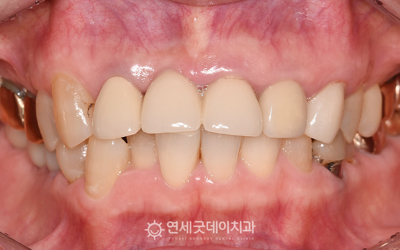 앞니 임플란트 브릿지 전 구내 모습