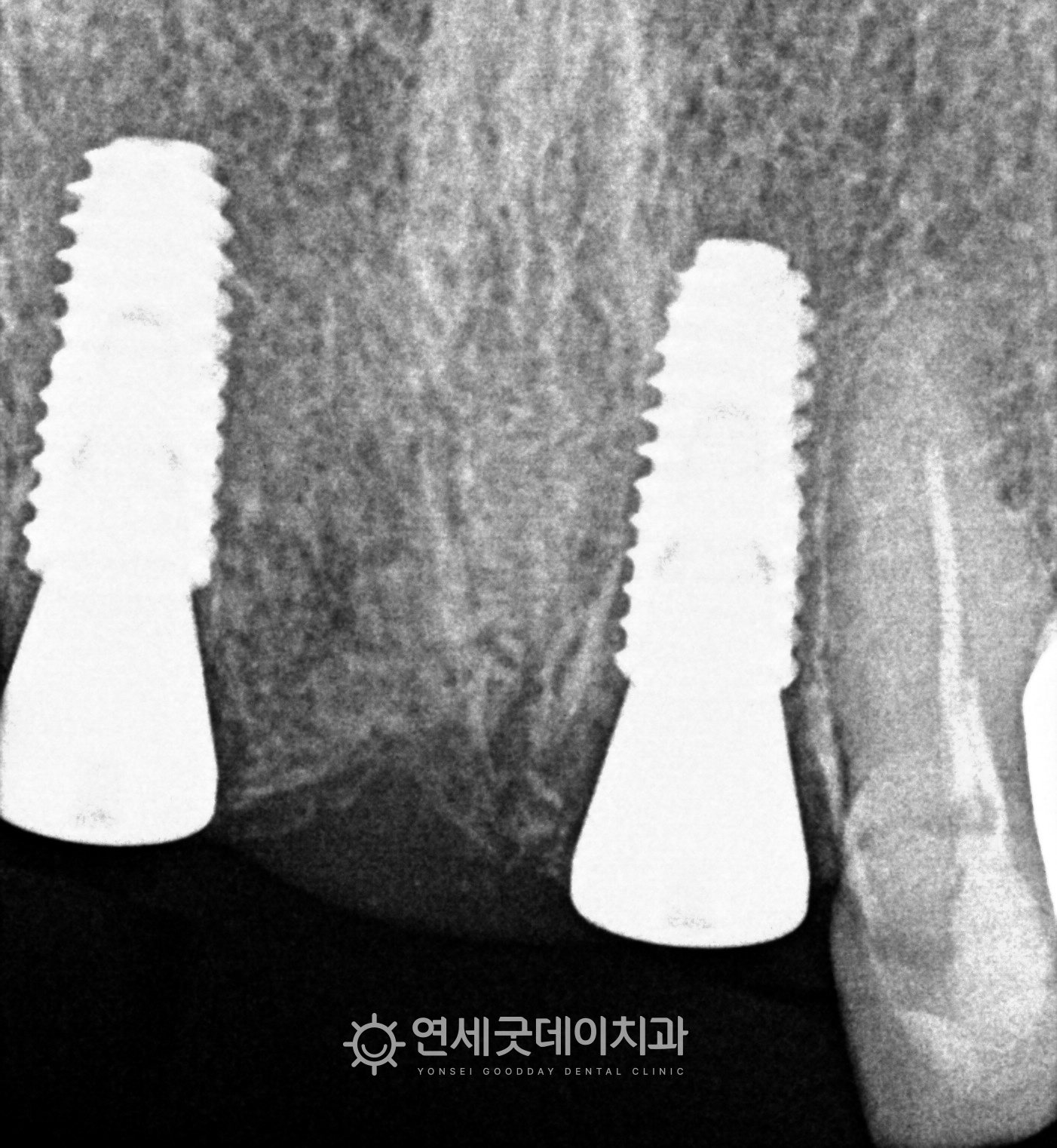 앞니 임플란트 브릿지 - 급속골이식 및 임플란트 식립