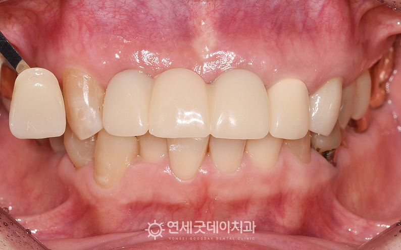 앞니 임플란트 브릿지 크라운 제작을 위한 쉐이드 대조 모습