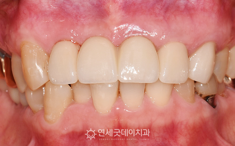 앞니 임플란트 치료 후 구내모습