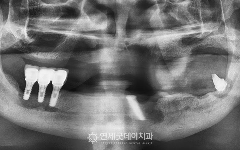 올온엑스 치료 전 아랫니 임플란트 부위에 심한 치조골소실 관찰