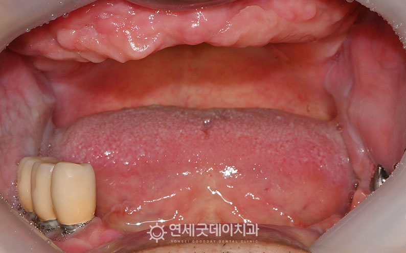 올온엑스 아랫니 임플란트 치료 전 모습