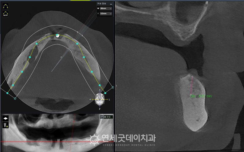 올온엑스, 아랫니 임플란트 식립을 위한 진단 과정