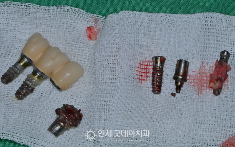 새로운 아랫니 임플란트 식립 전 기존 보철물 제거