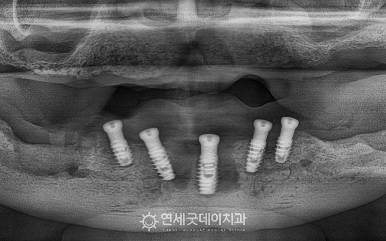 올온엑스를 위한 아랫니 임플란트 식립