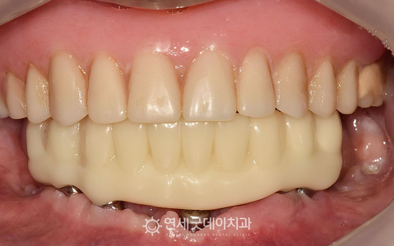올온엑스 임시 보철 장착