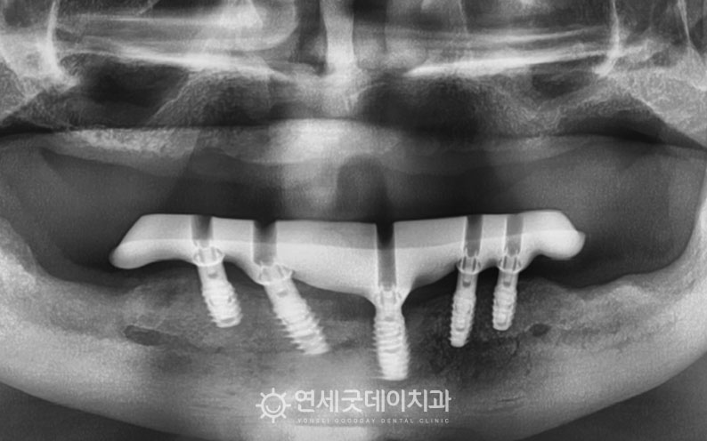 아랫니 임플란트에 밀드바 연결
