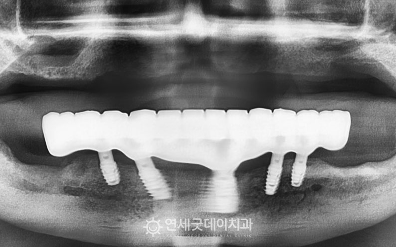 아랫니 임플란트와 밀드바 연결 후 최종 보철물 장착 (올온엑스)