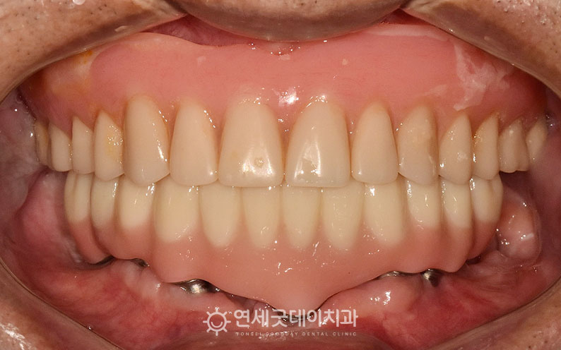 아랫니 임플란트 올온엑스 종결 후 구내 모습