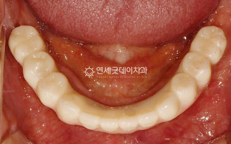 아랫니 임플란트 식립 후 모습