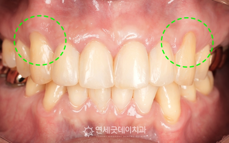 잇몸내려앉음으로 인해 잇몸이식수술 희망