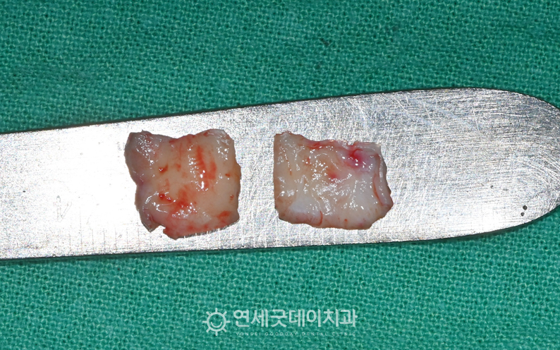 잇몸이식수술 과정 중 채취한 입천장 조직
