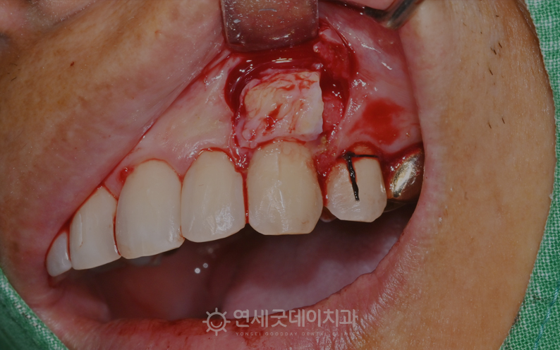 잇몸이식수술 과정 중 입천장 조직을 잇몸 내려앉음 부위에 이식함