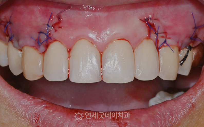 잇몸이식수술 후 봉합