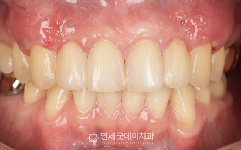 잇몸이식수술 이후 잇몸 내려앉음 부위의 외형이 복구됨