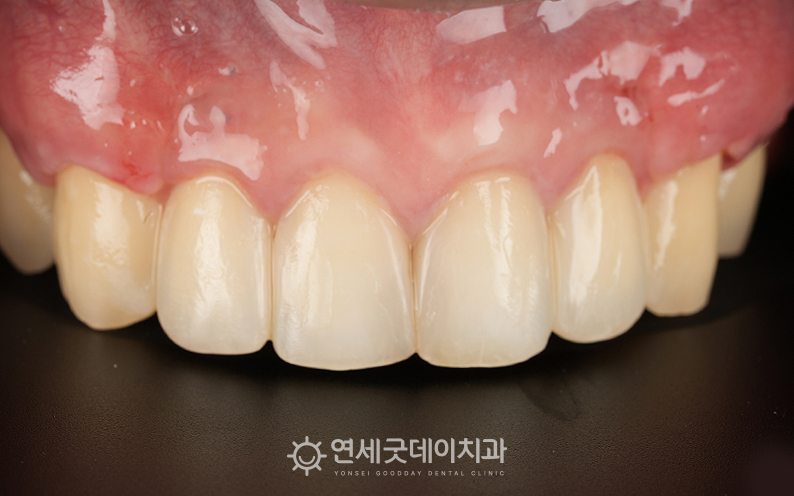 잇몸이식수술 이후 잇몸 내려앉음 부위의 외형이 개선됨