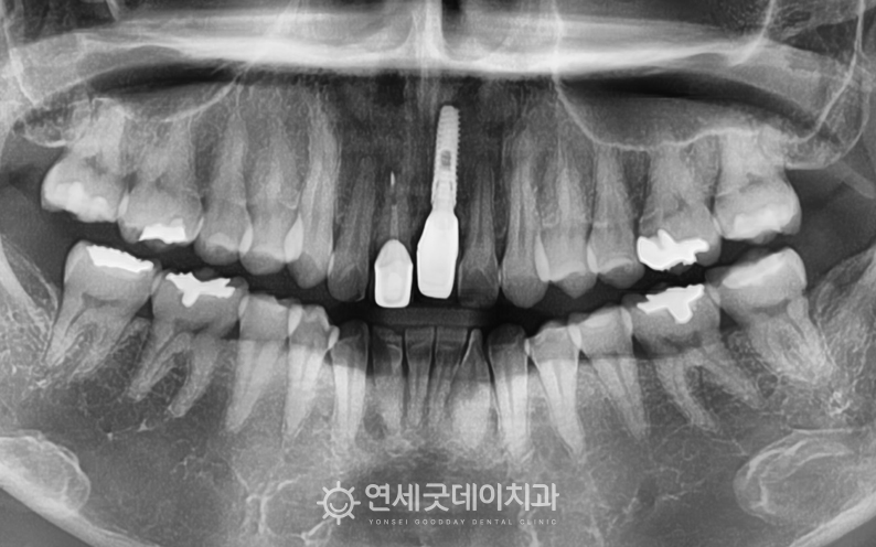 앞니 잇몸이식 및 앞니 브릿지 진행 전 엑스레이