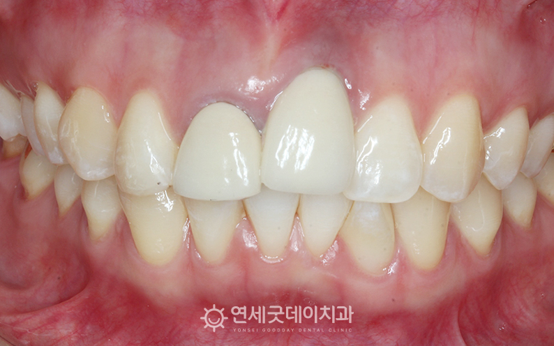 앞니 임플란트 제거 전 모습