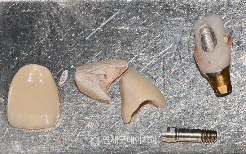 앞니 크라운 및 임플란트 제거한 부품들