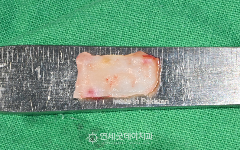 잇몸이식을 위한 입천장 조직 채취