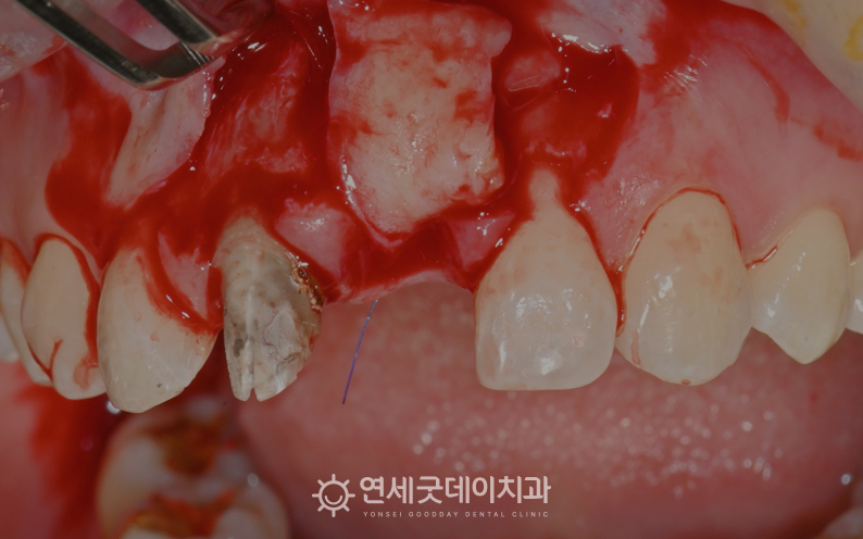 잇몸이식 진행 과정