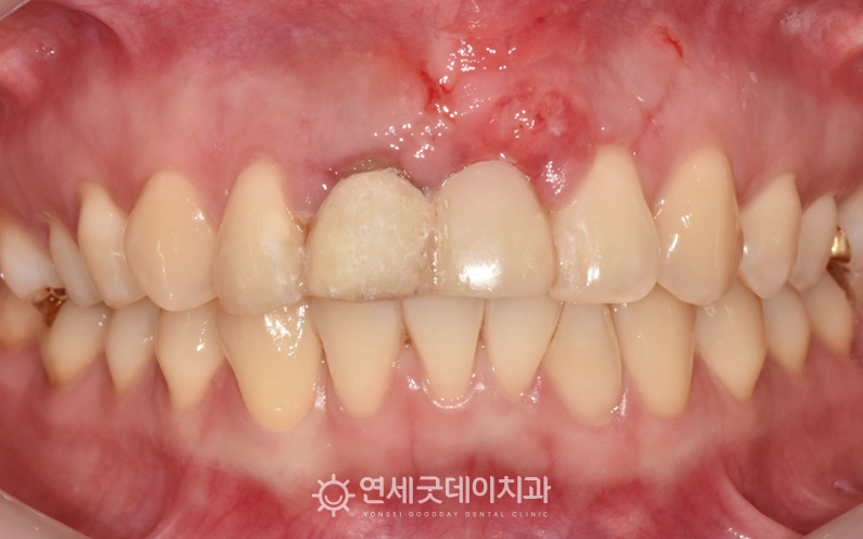 잇몸이식 경과체크 1