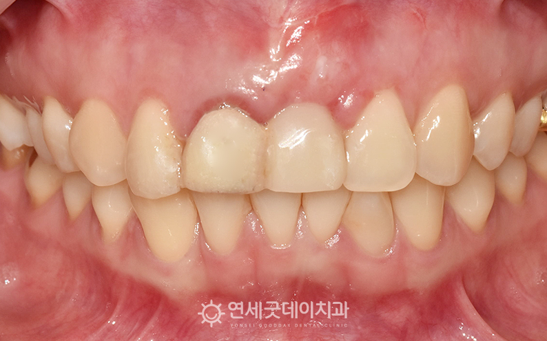 잇몸이식 경과체크2