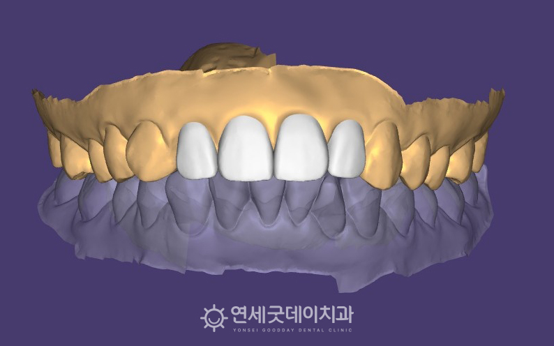 앞니 크라운 브릿지 제작을 위한 디자인 과정