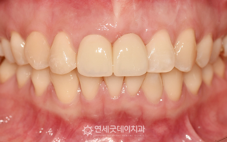 잇몸이식 및 앞니 크라운 브릿지 치료 종료