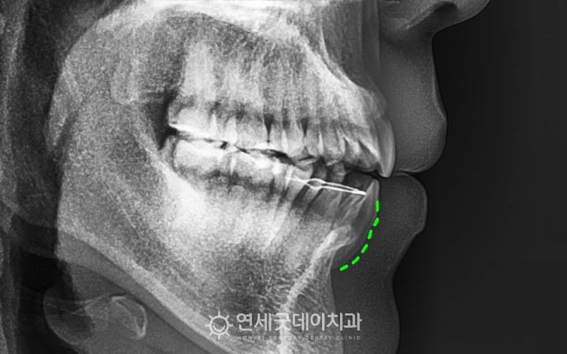 치아 뿌리 돌출로 인해 잇몸 내려앉음 발생