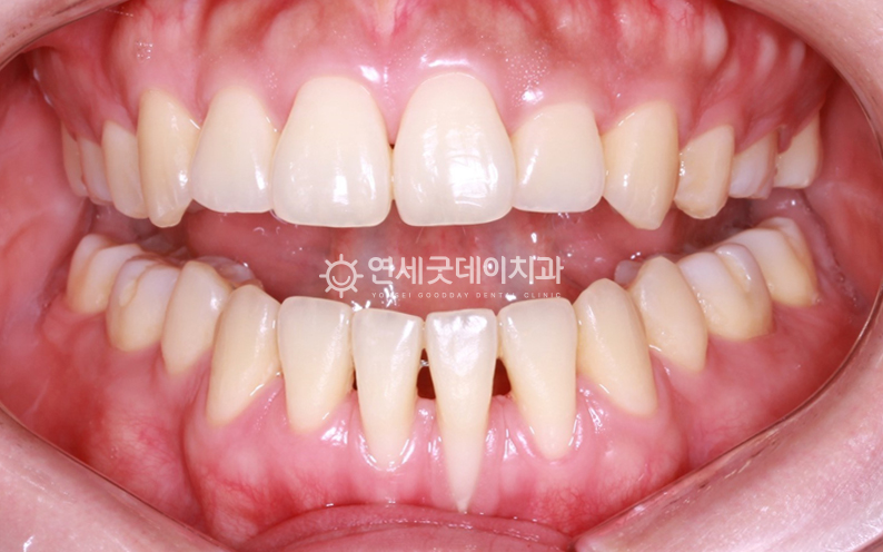 아랫니 부분교정 이후 잇몸 내려앉음이 일정부분 개선된 모습. 잇몸이식수술 진행 전