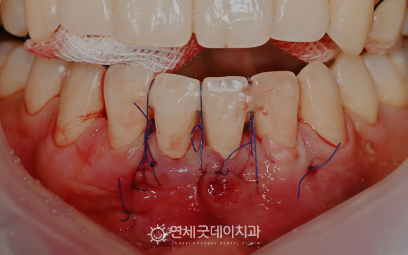 잇몸내려앉음 개선을 위해 잇몸이식수술 진행