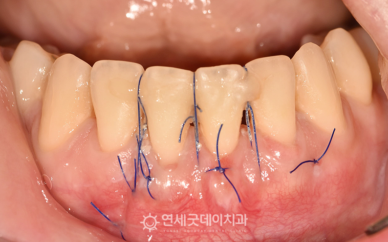 잇몸이식수술 진행 후 치유되는 과정