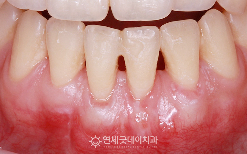 잇몸이식수술 이후 잇몸내려앉음이 개선되고 두툼하게 재생된 모습