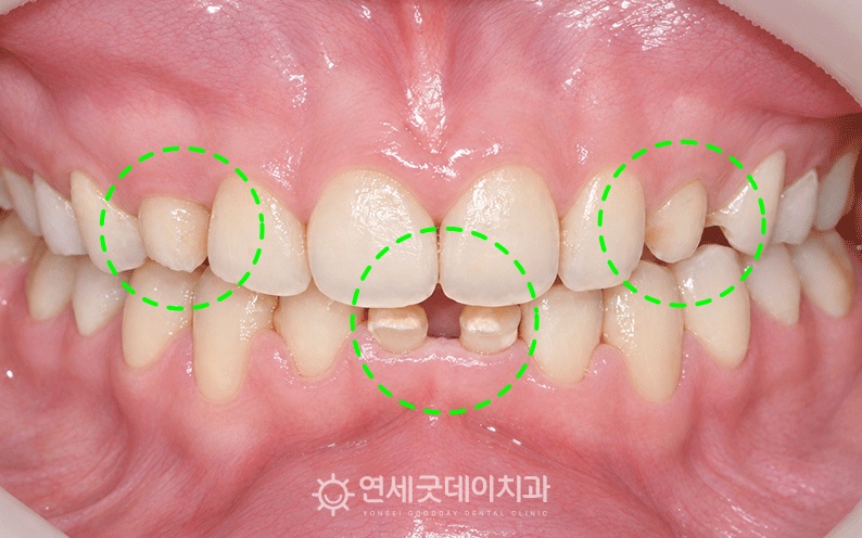 20대임플란트 전 유치가 존재하는 모습