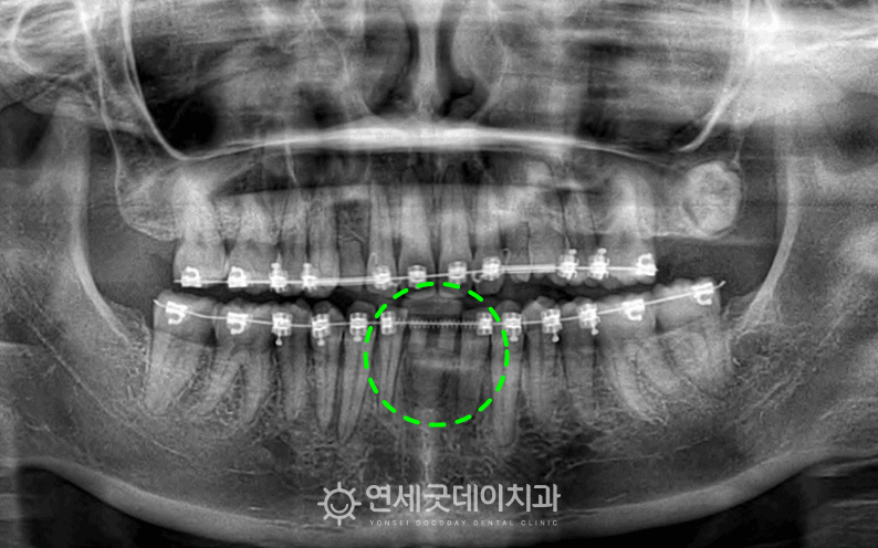 20대임플란트 전 하악의 잇몸이 매우 얇아 잇몸이식수술 필요