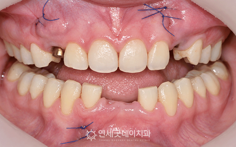 20대임플란트 유치 발치 후 임플란트 식립
