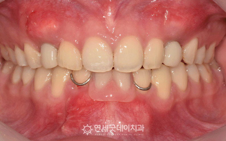 20대임플란트 임시 틀니 착용